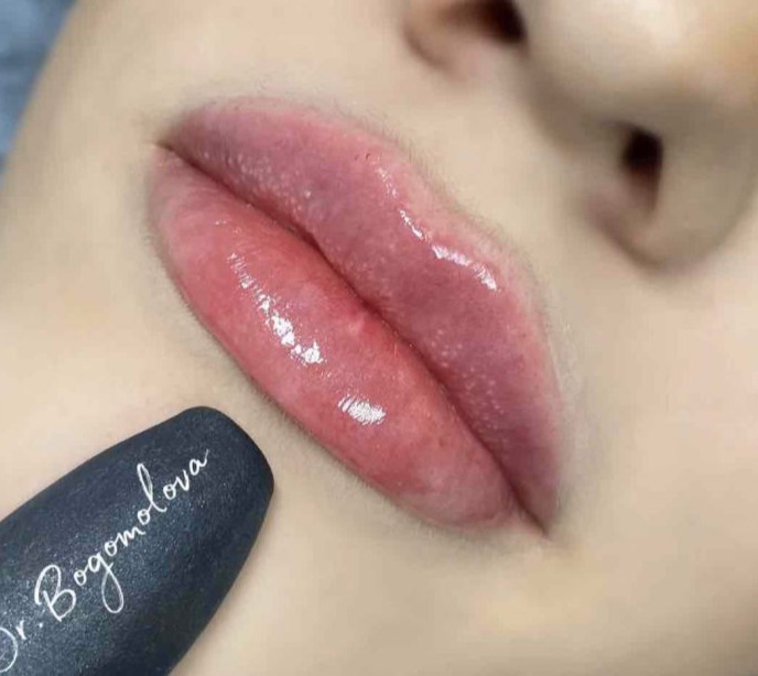 Konturna-plastyka-gub-Lviv