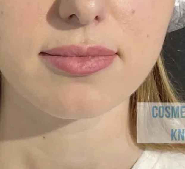 Konturna-plastyka-pidboriddya-Lviv-1